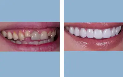 Before and After